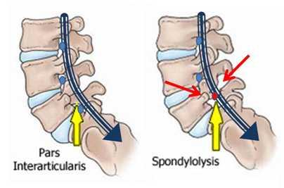 Traumatická spondylolistéza L5-S1 pars interarticularis Přední ventrální posun