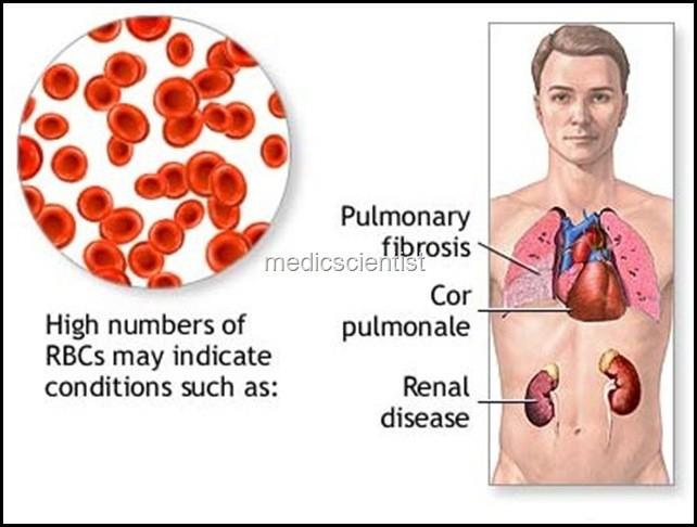 mozkové, koronární) polycythemia vera ( nižší hladina