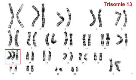 Počty chromozomů Patauův syndrom Edwardsův