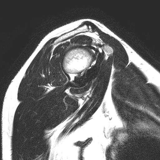 infraspinatus m.