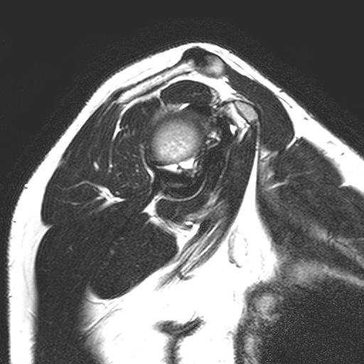 infraspinatus m.