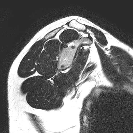 infraspinatus m.