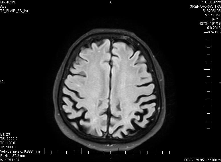 MRI a PET MRI dominuje biparietální