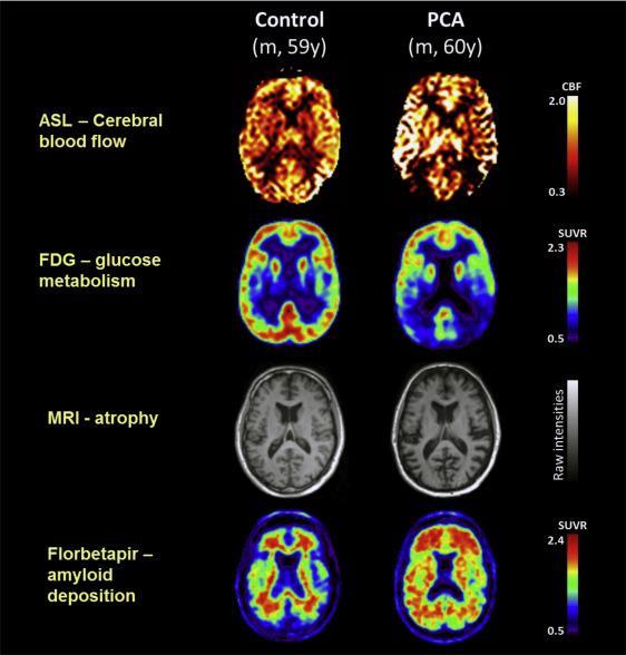 Zobrazovací kritéria Predominantní O- P nebo O-P-T atrofie/hypometabolismus/hypoperfuze MRI/FDG PET/SPECT PCA anatomie = PCA klinika Postižen dorsální proud vizuálního procesingu