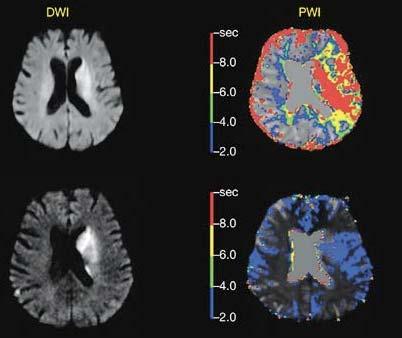 Penumbra na MR DWI ischemickátkáň světlá na
