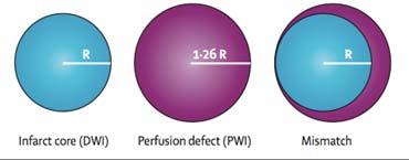 perfuzí penumbra již porušená perfuze (PWI) a