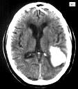 CT diagnostika CMP ischemie hemorhagie