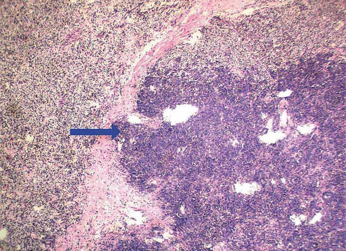 TUMOR-TO-TUMOR METASTASIS A UNIQUE CASE OF CLEAR CELL RENAL CELL CARCINOMA HARBORING METASTASIS Introduction The development of multiple primary malignant neoplasms in the same individual is not