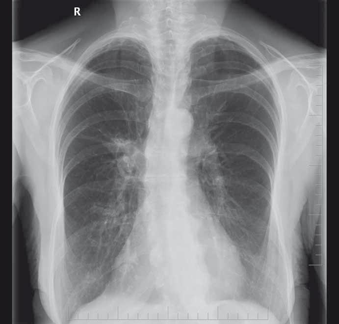 AFATINIB V LÉČBĚ POKROČILÉHO NEMALOBUNĚČNÉHO KARCINOMU PLIC (NSCLC) SE VZÁCNOU MUTACÍ EGFR afekce nebyly známky infektu.