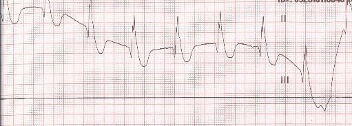 ECG