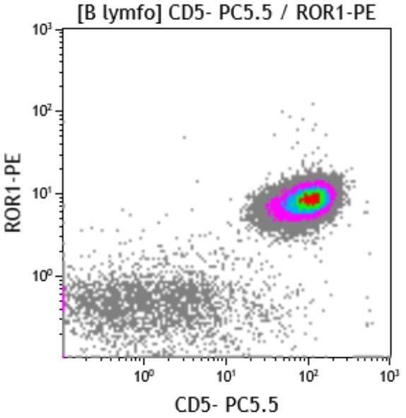 WBC CD5+, CD23+, CD200+,