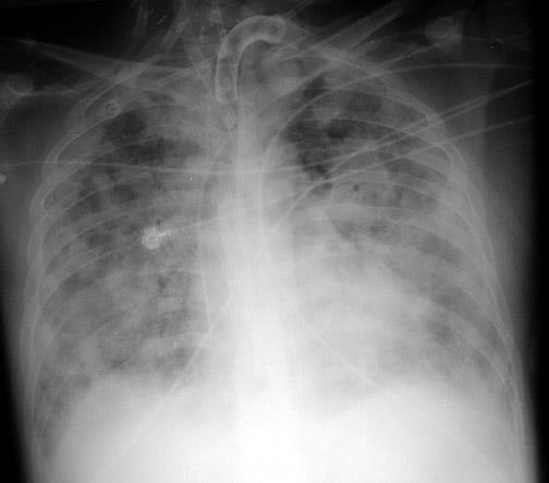 hypoxémie/hypoxie