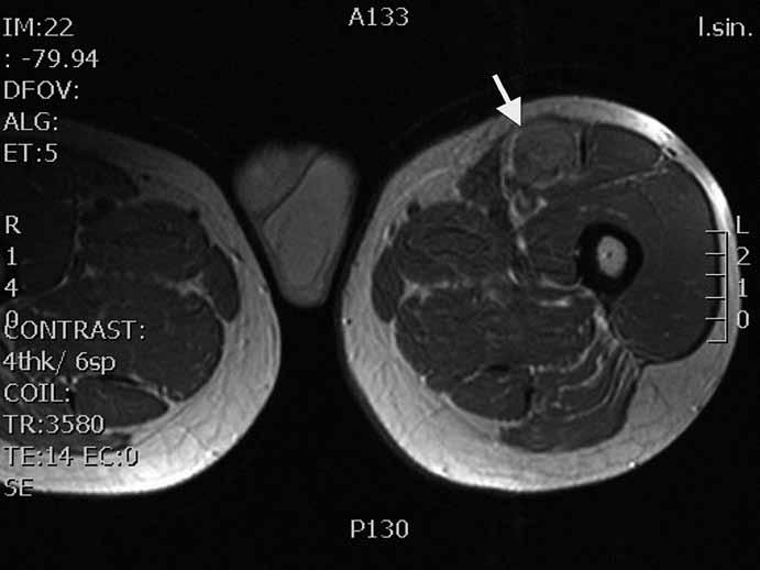 Summary Background: Malignant peripheral nerve sheath tumor schwannoma (MPNST), also known as malignant schwannoma, is a very rare tumor accounting for only 2% of all sarcomas.