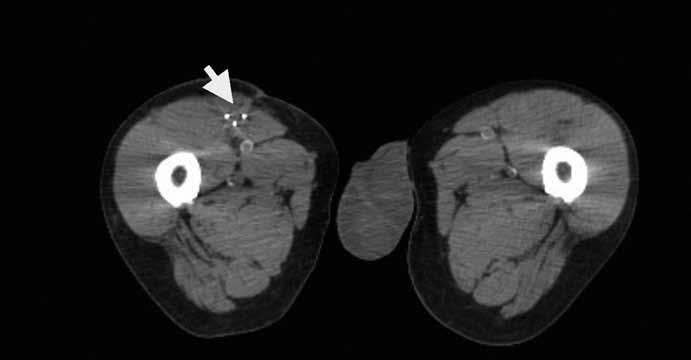V 10/ 2010 byla provedena radikální exstirpace nádoru vyrůstajícího ze svalové větve femorálního nervu na stehně. Histologický nález odhalil maligní schwannom (MPNST) a resekce byla hodnocena jako R0.