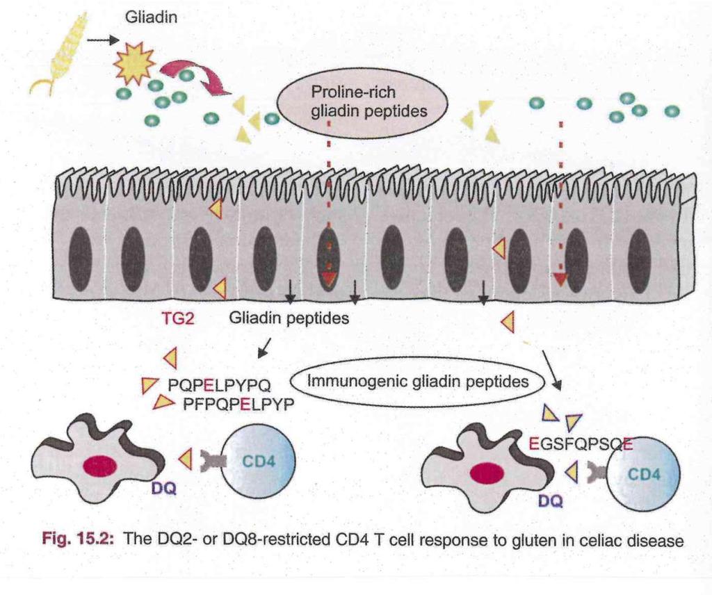 Imunogenetický mechanizmus nestrávené gliadinové fragmenty z lepku přítomné na intestinálním lumen jsou transportovány epiteliální vrstvou a v intaktní formě přecházejí do lamina propria, kde jsou