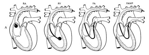 (pulmonary arterial