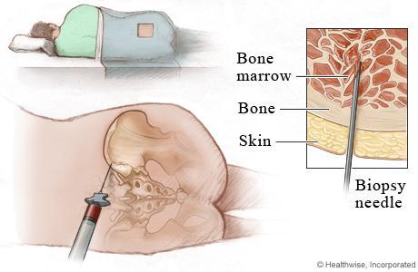 1.2.2 Členění podle zdroje buněk 1.2.2.1 Kostní dřeň Z lopaty kosti kyčelní se v celkové anestezii odebírá 10-15 ml dřeňové krve na 1 kg hmotnosti pacienta.