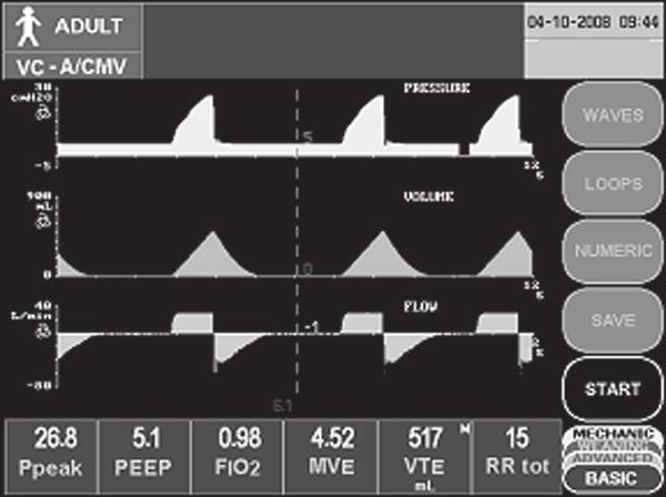 A Dodatok k modelu T Keď uvoľníte tlačidlo PV Maneuver a/alebo dych prejde na exhaláciu: ventilátor pokračuje v normálnej ventilácii; slučka Pressure Volume sa zmrazí; zobrazí sa rolovací displej.