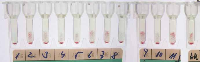 Obr. 1. Identifikace erytrocytových protilátek na gelové kartě DG Gel (Grifols) nediagnostický nález příčinou daratumumabu interferujícího v LISS-NAT.