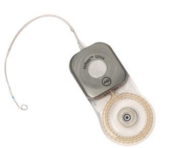 Jak pracuje kochleární implantát Systém kochleárního implantátu 3 Sluchová ztráta obecně znamená poškození v některé části vnitřního ucha neboli kochley, kde je zvuk přenášen do sluchového nervu.