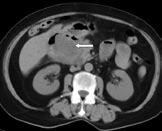 Obr. 3 Obr. 3. a 4. Aerobilie patrná na CT vyšetření s podáním bolusu kontrastní látky intravenózně v měkkotkáňovém okně (obr. 3) a plicním okně (obr. 4) Obr. 4 Fig. 3. and 4.