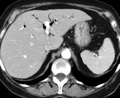 (Fig. 5), after intravenous administration of contrast agent (Fig. 6) and after oral administration of contrast medium which was crucial for establishing the diagnosis (Fig. 7). v trávicí trubici.