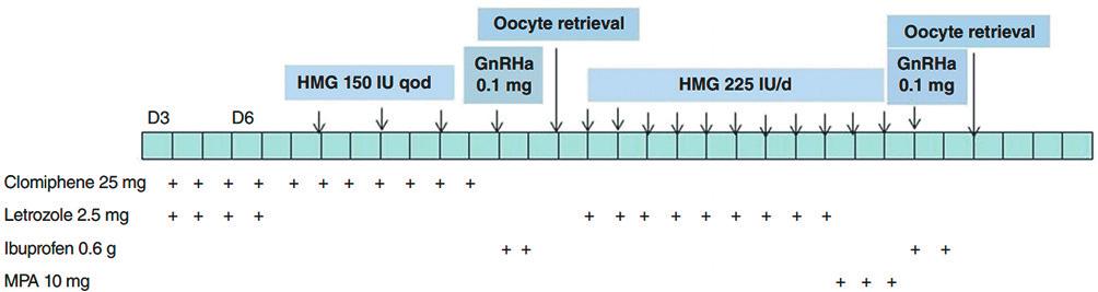 Obr. 1 Shanghai protokol (14) GnRHa agonista gonadotropin uvolňujícího hormonu, HMG humánní menopauzální gonadotropin, MPA medroxyprogesteron acetát, qod ob den (PGT-A) (63).