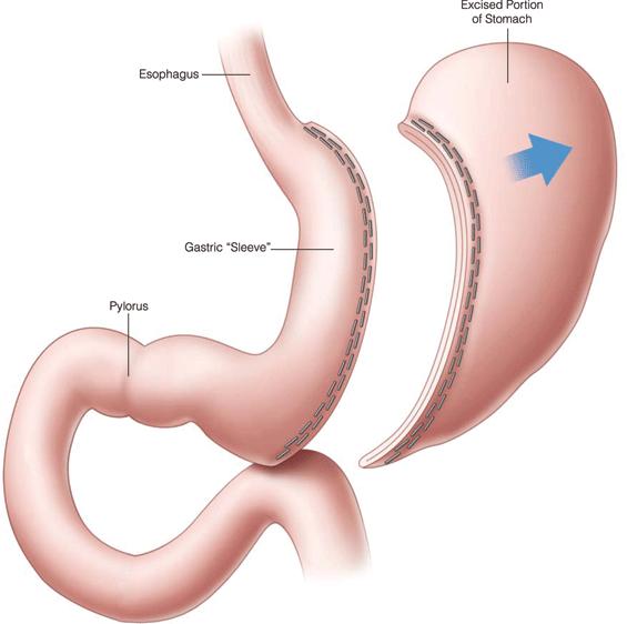 Mechanismus účinku této operace je primárně restrikční (resekce velké části žaludku), ale nepochybně se zde uplatňuje i výrazný efekt neurohormonální, kdy s resekcí žaludku dochází k výraznému