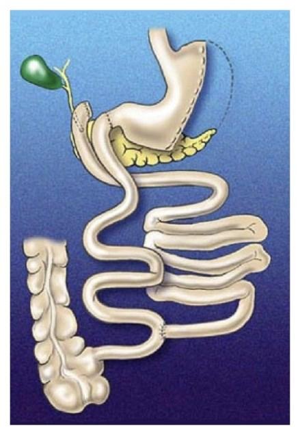 V dlouhodobém intervalu sledování dosahuje BPD/DS 70 %EWL, což z ní činí bariatrickou operaci s největším účinkem na pokles hmotnosti (162), ale zároveň je bariatrickou operací s nejvyšším procentem