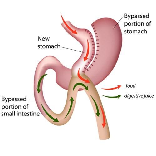 operace spočívá ve vytvoření malého žaludečního konduitu vertikálním přerušením žaludku podél malé křiviny od incisura angularis po Hissův úhel a anastomóze tohoto konduitu na vytaženou omega kličku