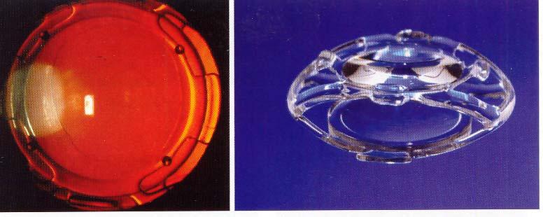 31 Princip funkce čočky LiquiLens (Vision Solution Technologies) Další inovací je LAL (Light adjustable lens, Calhoun Vision) tří kusová nitrooční čočka obsahující fotosenzitivní