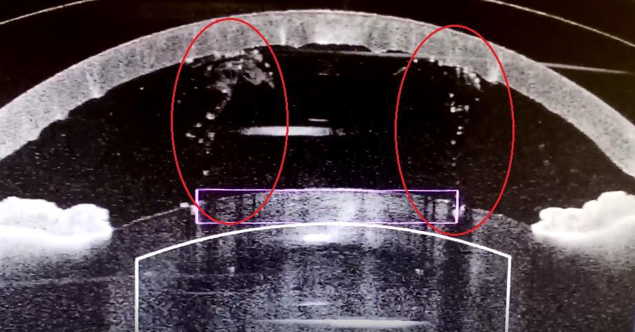 Tento předpoklad potvrzuje i starší studie zabývající se vlivem fotodisrupce Nd:YAG laserem na tkáň, který se používá např. při léčbě sekundární katarakty.