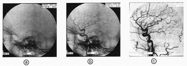 Kontrastní látky v RTG subtrakční angiografie Cílem je zobrazit pouze cévní struktury (cévní strom) naplněné kontrastní látkou- DSA (Digital Subtraction Angiography).