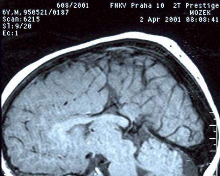 3 Anomálie corpus callosum (T1W obraz) Corpus callosum se na sagitálních řezech znázorňuje jako obloukovitý útvar stejné