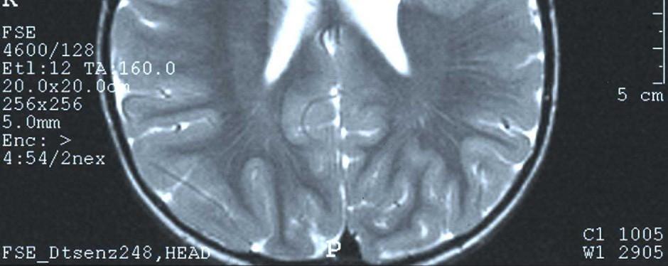 Na obrázku je schizencefalie patrná jako tenká štěrbina obklopená ektopickou šedou hmotou, která zasahuje až ke kontuře rozšířené levé postranní komory.