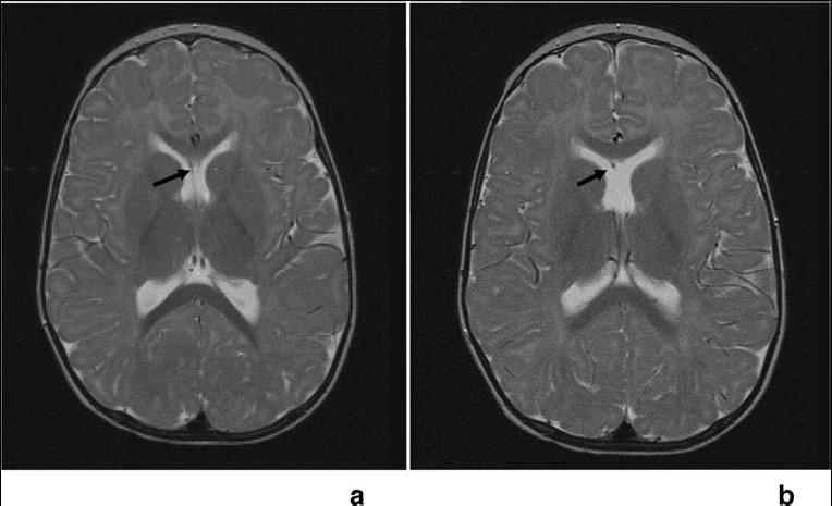 Results Patient selection Out of 68 patients with ONH, 30 had an SP abnormality consistent with SOD. Twenty-two of them had complete SP absence and eight had partial SP absence/sp remnants (Fig. 1).