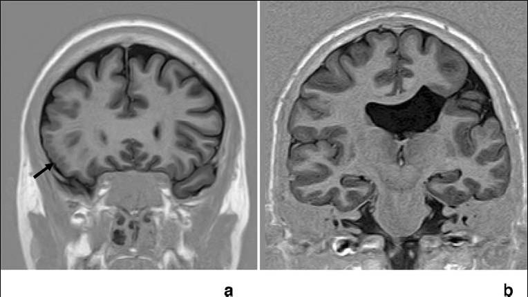 deficiency. Overall, a pituitary anomaly was less frequently seen in patients with SP remnants (p=0.053). Severe pituitary anomalies were significantly correlated with pituitary deficiency (p<0.