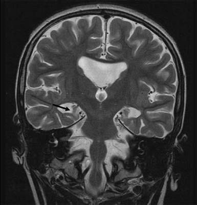 Fig. 3 Coronal T2-weighted image: missing septum pellucidum, hypoplastic corpus callosum, and sagittalized hippocampus (arrow) Fig.