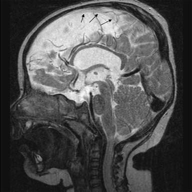 patients with hippocampus and falx abnormality.