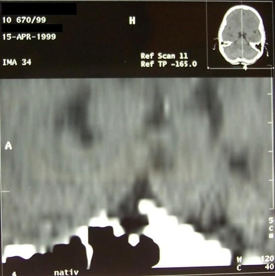 řez) hypofýzy 2,9x3,7 mm (MRI T2W sagitální řez) Pacient 2 -