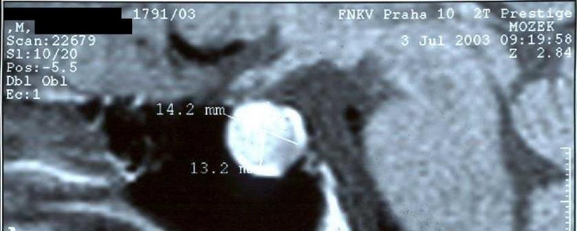 hypofýzy 16x14x13 mm (MRI T1W