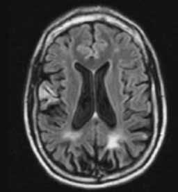 FT ložisko je subakutní s poruchou hematoencefalické bariéry i s metabolickou aktivitou (hypersignální proužek v MTC viz bílá šipka), atrofie kortikální a periventrikulární. Fig. 1. E.M., NPSLE patient with clinical stroke, 35 years old, MRI, 1.