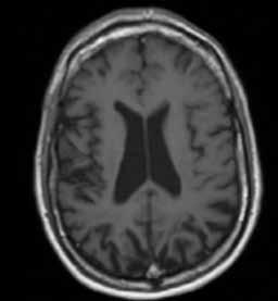 A T2-weighted image in UTSE mode; B D strongly T2-weighted images of FLAIR mode; E T1-weighted image in SE mode; F, G T1 weighted image in SE mode with magnetization transfer; H T1-weighted image in