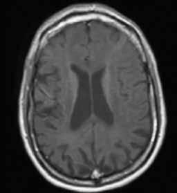 Dispersely distributed multiple hypersignal lesions corresponding to vasculopathy/vasculitis in the white matter of both hemispheres in supratentorial region in T2 weighted and FLAIR images.