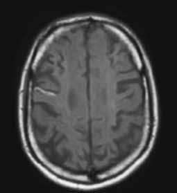 FT lesions is subacute with impaired blood-brain barrier and metabolic activity (hypersignal strip in MTC see white arrow), cortical and periventricular atrophy. Tab. 1.