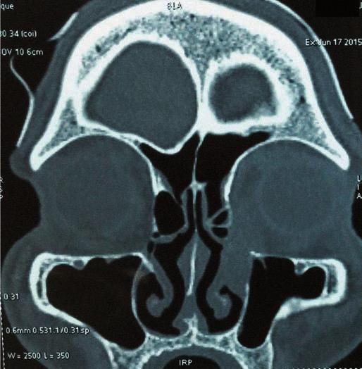 PRIMARY MUCOEPIDERMOID CARCINOMA OF THE LACRIMAL SAC A CASE REPORT AND LITERATURE REVIEW Introduction Primary lacrimal passage malignancies are very uncommon [1 3].