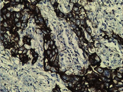PRIMARY MUCOEPIDERMOID CARCINOMA OF THE LACRIMAL SAC A CASE REPORT AND LITERATURE REVIEW Fig. 4. Immunohistochemistry photograph showing positive immunoreactivity for EGFR. Fig. 5.