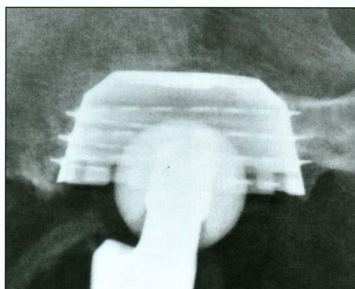 Uncemented cup Secondary fixation: