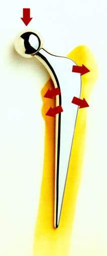 Femoral component High polished surface for cementing