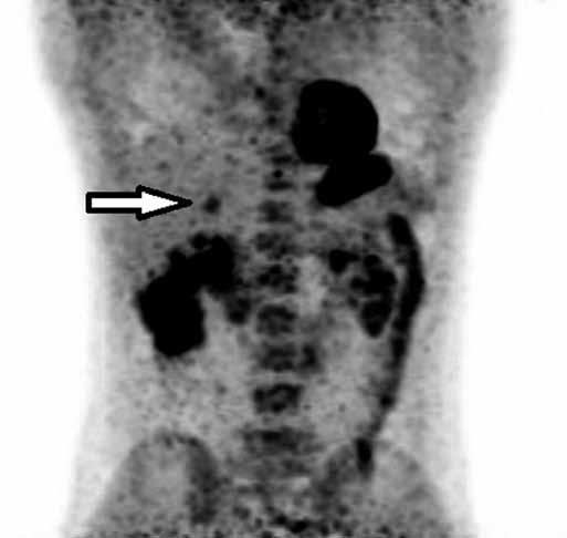 Ces Radiol 20; 72(1): 46 50 Obr. 4 Obr. 5 Obr. 4. F-FDG PET/CT, PET 3D rekonstrukce za 0 minut po i.v. aplikaci radiofarmaka.
